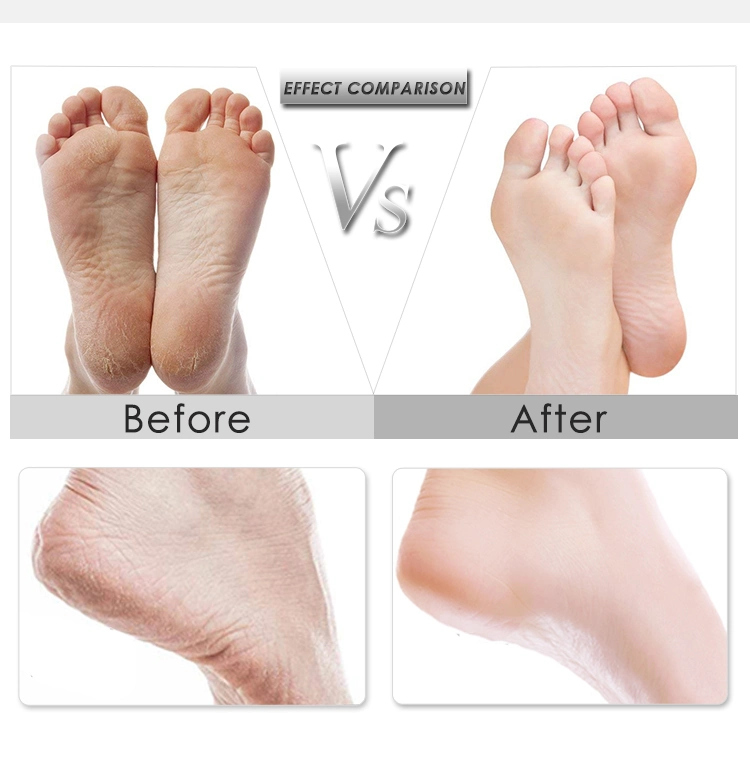 Factory Electric Foot Callus Remover Best Care for Foot Dry Dead Skin